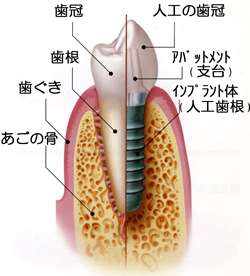 インプラントとは?
