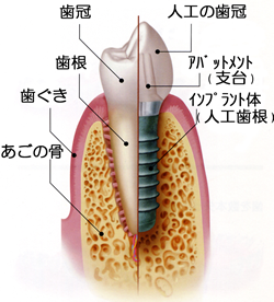 インプラントとは？