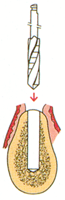 Step2 インプラント手術