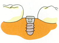 Step3 インプラントと骨がくっつくのを待つ