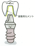 完全に固定する方法