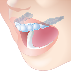 マウスピース ナイトガード 戸塚 歯医者 佐々木歯科医院