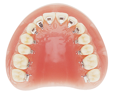 裏側の矯正治療