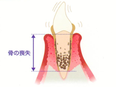 歯周病が進行すると